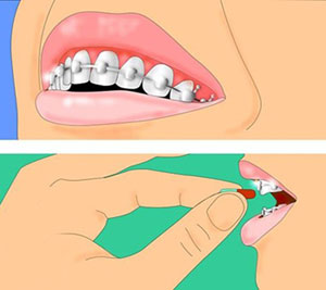 التهاب لثه ها, ارتودنسی, نظم دادن به دندان ها