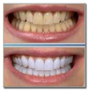 جرم دندان چیست،جرم دندان،جرم گیری دندان،دهان و دندان