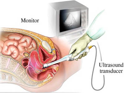سونوگرافی،سونوگرافی از طریق واژن،سونوگرافی فراصوتی،حاملگی،ترانس واژینال،دوران بارداری،بهداشت بانوان