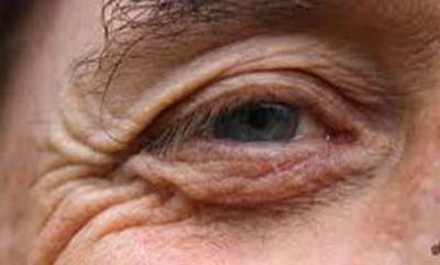درمان چین و چروک در اطراف چشم