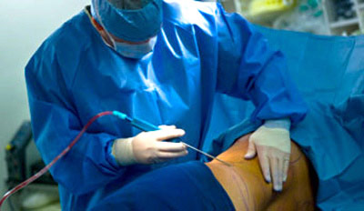 جراحی ابدومینوپلاستی,عمل جراحی زیبایی شکم