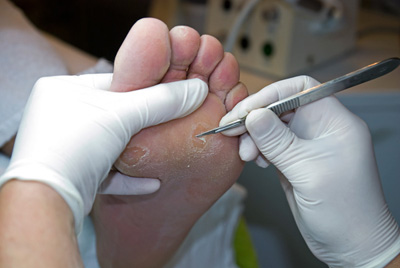 روش درمان میخچه پا , قطره دارویی برای درمان میخچه